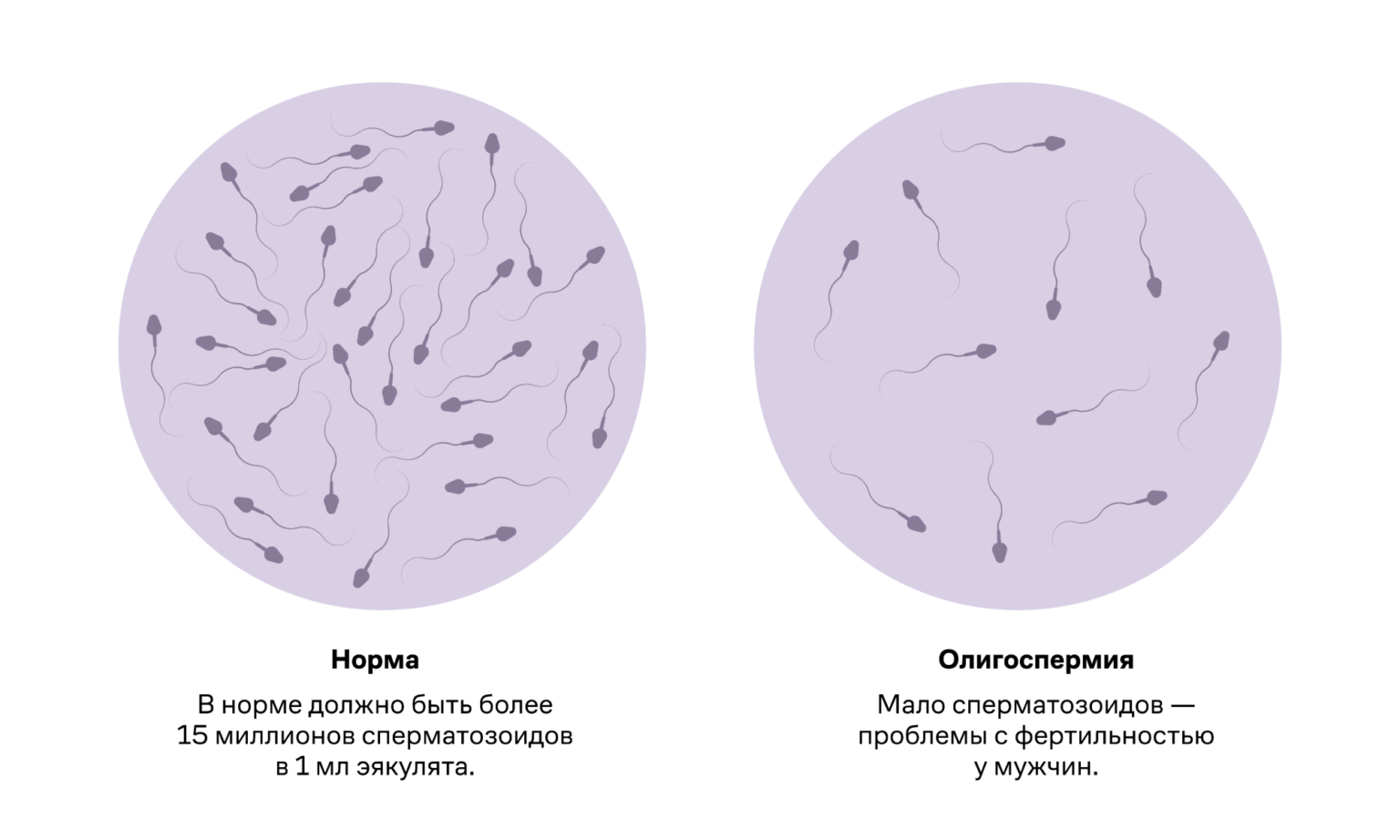 Мало эякулята. Обструктивная азооспермия. Олигоспермия. Олигоспермия азооспермия. Олигоспермия причины.