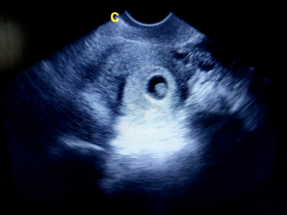 Анэмбриония – замершая беременность. Анэмбриония симптомы на ранних сроках.